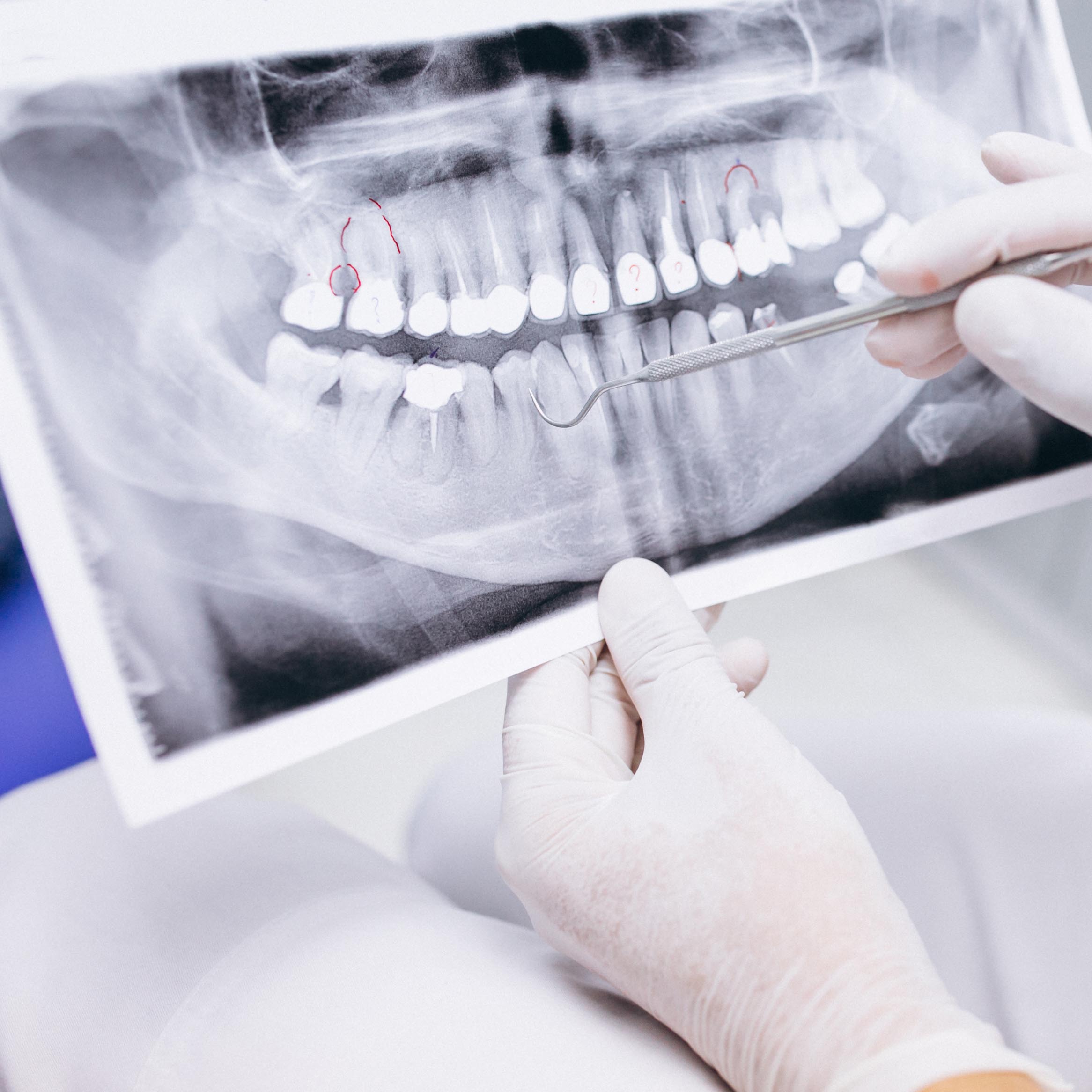 X-ray of teeth